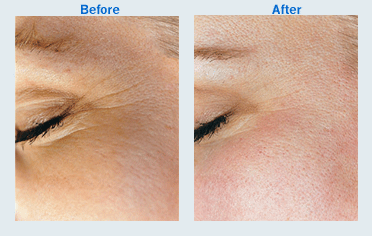 Medical Microdermabrasion
