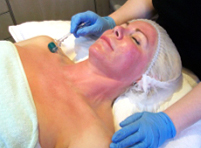 Skin Needling 