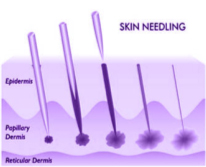 Skin Needling 