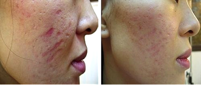 Skin Needling